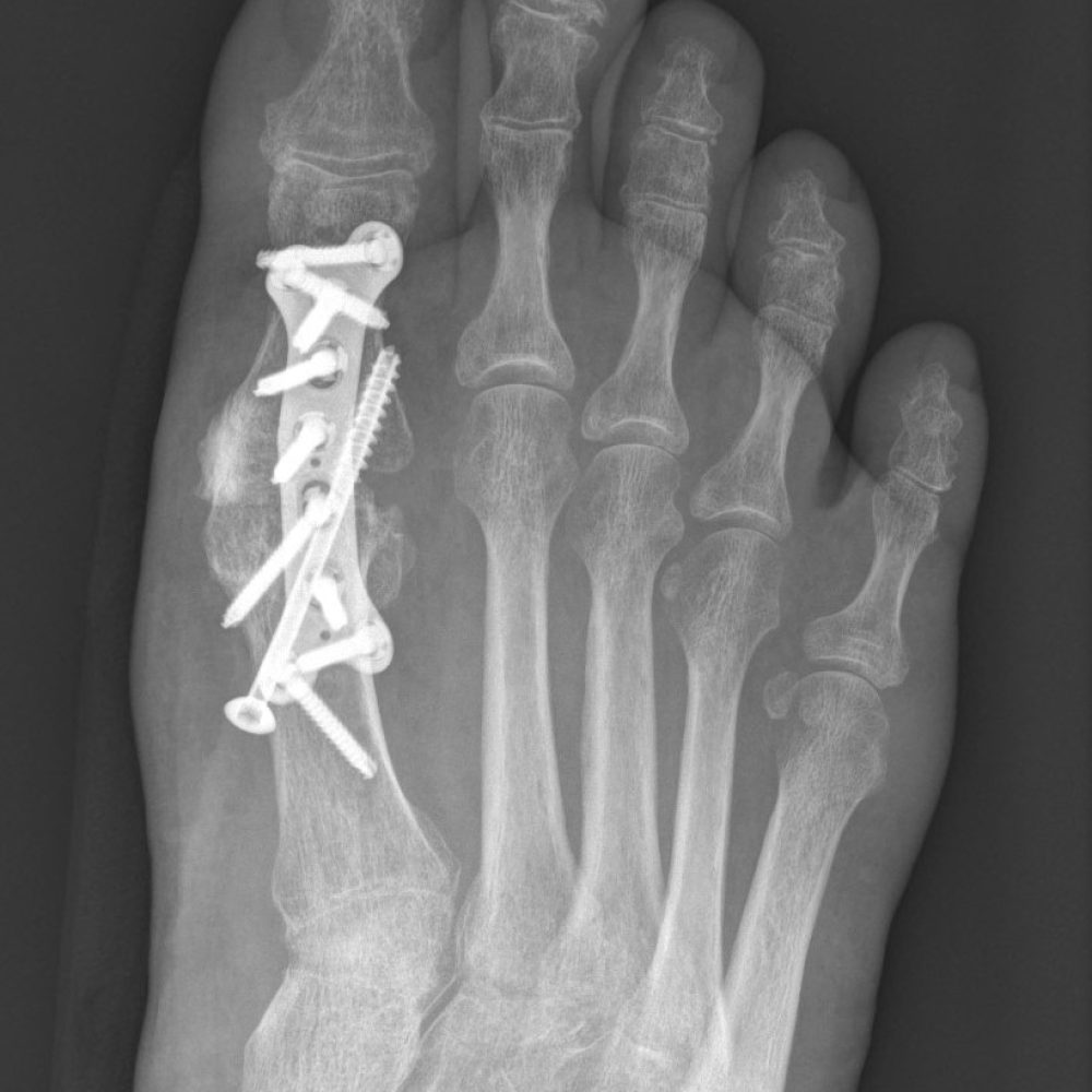 Hallux-valgus-Verlaengerung